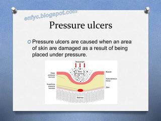 Pressure ulcers
O Pressure ulcers are caused when an area
of skin are damaged as a result of being
placed under pressure.
 