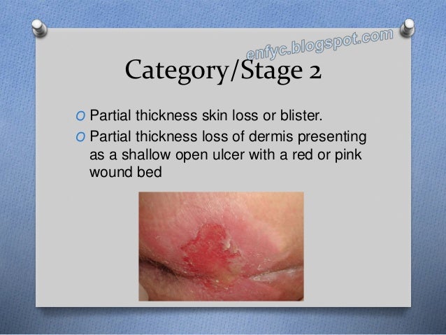 Pressure ulcers