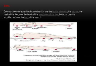 Sites :
Common pressure sore sites include the skin over the ischial tuberosity, the sacrum, the
heels of the feet, over the heads of the long bones of the foot, buttocks, over the
shoulder, and over the back of the head.[5]
 