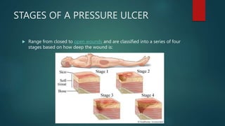 STAGES OF A PRESSURE ULCER
 Range from closed to open wounds and are classified into a series of four
stages based on how deep the wound is:
 