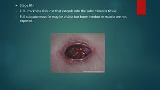 Stage III:-
o Full- thickness skin loss that extends into the subcutaneous tissue.
o Full subcutaneous fat may be visible but bone, tendon or muscle are not
exposed.
 