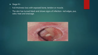  Stage IV:-
o Full thickness loss with exposed bone, tendon or muscle.
o The skin has turned black and shows signs of infection- red edges, pus,
odor, heat and drainage.
 