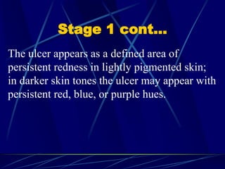 Stage 1 cont…
The ulcer appears as a defined area of
persistent redness in lightly pigmented skin;
in darker skin tones the ulcer may appear with
persistent red, blue, or purple hues.
 
