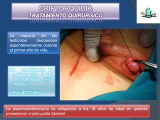 CRIPTORQUIDIA
           TRATAMIENTO QUIRÚRGICO


 La     mayoría    de   los
 testículos     descienden
 espontáneamente durante
 el primer año de vida.



 La     orquidopexia se
   realiza entre 1 y 2
   años de edad (6-12
   meses )

 ORQUIECTOMIA


La espermatobioscopía es obligatoria a los 16 años de edad en quienes
presentaron criptorquidia bilateral
 