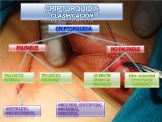 CRIPTORQUIDIA
                   CLASIFICACIÓN

                      CRIPTORQUIDIA



     PALPABLE                                      NO PALPABLE




TRAYECTO        TRAYECTO              AUSENTE            Intra- abdominal
NORMAL          ANORMAL               (Anorquia-           (criptorquidia
                                      Monorquia)            verdadera)




                      INGUINAL SUPERFICIAL
RETRACTIL            PERINEAL
NO RETRACTIL         FEMORAL
 