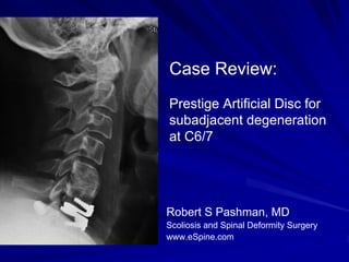Case Review:
Prestige Artificial Disc for
subadjacent degeneration
at C6/7




Robert S Pashman, MD
Scoliosis and Spinal Deformity Surgery
www.eSpine.com
 