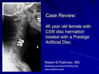 Case Review:

46 year old female with
C5/6 disc herniation
treated with a Prestige
Artificial Disc



Robert S Pashman, MD
Scoliosis and Spinal Deformity
www.eSpine.com
 