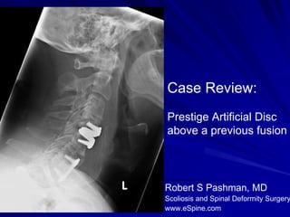 Case Review:
Prestige Artificial Disc
above a previous fusion




Robert S Pashman, MD
Scoliosis and Spinal Deformity Surgery
www.eSpine.com
 