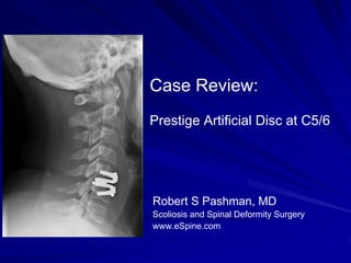 Case Review:
Prestige Artificial Disc at C5/6




Robert S Pashman, MD
Scoliosis and Spinal Deformity Surgery
www.eSpine.com
 