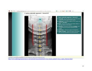 http://www.radiologymasterclass.co.uk/tutorials/musculoskeletal/x-ray_trauma_spinal/x-ray_c-spine_fracture.html
12
 
