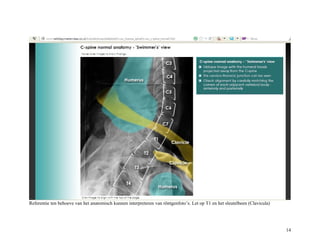 Referentie ten behoeve van het anatomisch kunnen interpreteren van röntgenfoto’s. Let op T1 en het sleutelbeen (Clavicula)
14
 