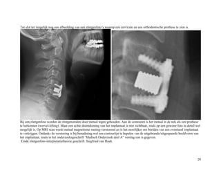 Tot slot ter vergelijk nog een afbeelding van een röntgenfoto’s waarop een cervicale en een orthodentische prothese te zien is.
Bij een röntgenfoto worden de röntgenstralen door metaal tegen gehouden. Aan de contouren is het metaal in de nek als een prothese
te herkennen (wervel-lifting). Maar een echte doortekening van het implantaat is niet zichtbaar, zoals op een gewone foto in detail wel
mogelijk is. Op MRI scan werkt metaal magnetisme meting-verstorend en is het moeilijker om beelden van een eventueel implantaat
te verkrijgen. Ondanks de verstoring is bij benadering wel een contourlijn te bepalen van de uitgebrande/uitgespaarde beeldvorm van
het implantaat, zoals in het onderzoeksgeschrift ‘Medisch Onderzoek deel A” verslag van is gegeven.
Einde röntgenfoto-interpretatietheorie geschrift. Siegfried van Hoek
20
 