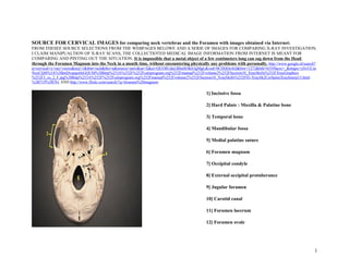 SOURCE FOR CERVICAL IMAGES for comparing neck vertebrae and the Foramen with images obtained via Internet:
FROM THESEE SOURCE SELECTIONS FROM THE WEBPAGES BELOWE AND A SERIE OF IMAGES FOR COMPARING X-RAY INVESTIGATION.
I CLAIM MANIPUALTION OF X-RAY SCANS, THE COLLECTIOTED MEDICAL IMAGE INFORMATION FROM INTERNET IS MEANT FOR
COMPARING AND PINTING OUT THE SITUATION. It is impossible that a metal object of a few centimeters long can sag down from the Head
through the Foramen Magnum into the Neck in a month time, without encountering physically any problems with personally. http://www.google.nl/search?
q=cervical+x+ray+views&noj=1&tbm=isch&tbo=u&source=univ&sa=X&ei=QUO8UduLBImSOK63gMgL&ved=0CDQQsAQ&biw=1272&bih=655#facrc=_&imgrc=ySvUCze
NoyCIjM%3A%3BmDvepqotfeGQUM%3Bhttp%253A%252F%252Fcalsprogram.org%252Fmanual%252Fvolume2%252FSection10_XraySkills%252FXrayGraphics
%252F3_xs_2_F.jpg%3Bhttp%253A%252F%252Fcalsprogram.org%252Fmanual%252Fvolume2%252FSection10_XraySkills%252F03-XraySk2CerSpineXrayInterp13.html
%3B719%3B761 AND http://www.flickr.com/search/?q=foramen%20magnum
1] Incissive fossa
2] Hard Palate : Maxilla & Palatine bone
3] Temporal bone
4] Mandibular fossa
5] Medial palatine suture
6] Foramen magnum
7] Occipital condyle
8] External occipital protuberance
9] Jugular foramen
10] Carotid canal
11] Foramen lacerum
12] Foramen ovale
1
 