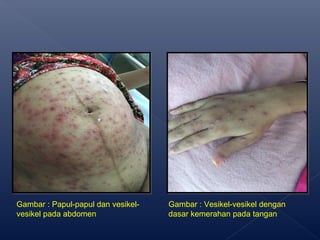 Gambar : Papul-papul dan vesikel-
vesikel pada abdomen
Gambar : Vesikel-vesikel dengan
dasar kemerahan pada tangan
 