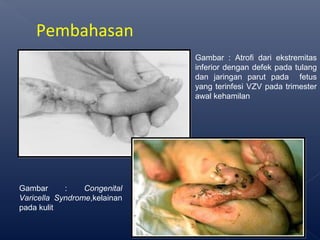 Pembahasan
Gambar : Atrofi dari ekstremitas
inferior dengan defek pada tulang
dan jaringan parut pada fetus
yang terinfesi VZV pada trimester
awal kehamilan
Gambar : Congenital
Varicella Syndrome,kelainan
pada kulit
 