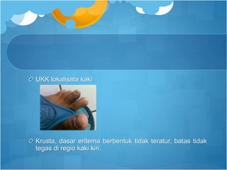 UKK lokalisata kaki
Krusta, dasar eritema berbentuk tidak teratur, batas tidak
tegas di regio kaki kiri.
 