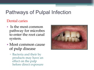 Pathways of Pulpal Infection
Dental caries
• Is the most common
  pathway for microbes
  to enter the root canal
  system.
• Most common cause
  of pulp disease
  ▫ Bacteria and their by
    products may have an
    effect on the pulp
    before direct exposure
 