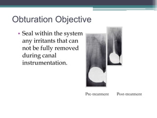 Obturation Objective
 • Seal within the system
   any irritants that can
   not be fully removed
   during canal
   instrumentation.




                            Pre-treatment   Post-treatment
 