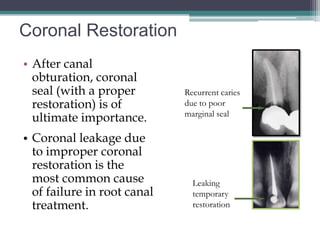 Coronal Restoration
• After canal
  obturation, coronal
  seal (with a proper        Recurrent caries
  restoration) is of         due to poor
                             marginal seal
  ultimate importance.
• Coronal leakage due
  to improper coronal
  restoration is the
  most common cause            Leaking
  of failure in root canal     temporary
  treatment.                   restoration
 