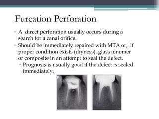 Furcation Perforation
▫ A direct perforation usually occurs during a
  search for a canal orifice.
▫ Should be immediately repaired with MTA or, if
  proper condition exists (dryness), glass ionomer
  or composite in an attempt to seal the defect.
   Prognosis is usually good if the defect is sealed
    immediately.
 