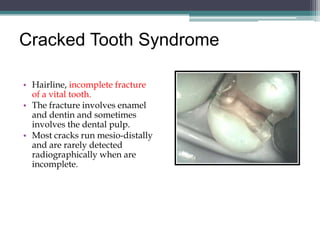 Cracked Tooth Syndrome

• Hairline, incomplete fracture
  of a vital tooth.
• The fracture involves enamel
  and dentin and sometimes
  involves the dental pulp.
• Most cracks run mesio-distally
  and are rarely detected
  radiographically when are
  incomplete.
 