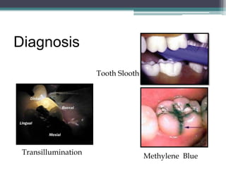 Diagnosis
                     Tooth Slooth




 Transillumination                  Methylene Blue
 