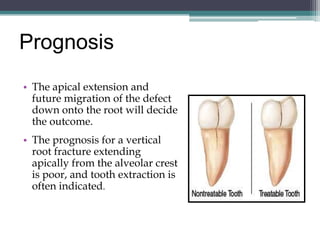 Prognosis
• The apical extension and
  future migration of the defect
  down onto the root will decide
  the outcome.
• The prognosis for a vertical
  root fracture extending
  apically from the alveolar crest
  is poor, and tooth extraction is
  often indicated.
 