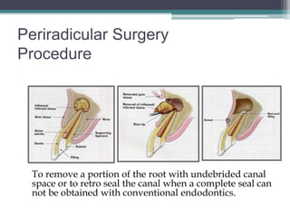 Periradicular Surgery
Procedure




  To remove a portion of the root with undebrided canal
  space or to retro seal the canal when a complete seal can
  not be obtained with conventional endodontics.
 
