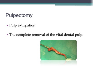 Pulpectomy
• Pulp extirpation

• The complete removal of the vital dental pulp.
 
