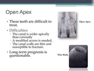 Open Apex
• These teeth are difficult to                  Open Apex
  treat.
• Difficulties:
  ▫ The canal is wider apically
    than coronally
  ▫ A modified access is needed.
  ▫ The canal walls are thin and
    susceptible to fracture.
• Long-term prognosis is
  questionable.                    Thin Walls
 