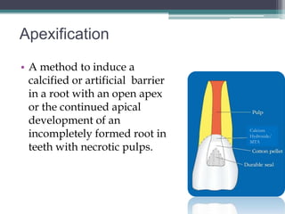 Apexification
• A method to induce a
  calcified or artificial barrier
  in a root with an open apex
  or the continued apical
  development of an
  incompletely formed root in       Calcium
                                    Hydroxide/
                                    MTA
  teeth with necrotic pulps.
 