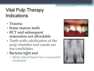 Vital Pulp Therapy
Indications
• Trauma
• Some mature teeth
• RCT and subsequent
  restoration not affordable
• Teeth with calcification of the
  pulp chamber and canals are
  not candidates
• Bacteria tight seal
  ▫ Most critical factor for a successful
    treatment
 