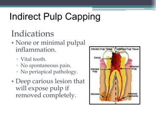Indirect Pulp Capping
Indications
• None or minimal pulpal
  inflammation.
 ▫ Vital tooth.
 ▫ No spontaneous pain.
 ▫ No periapical pathology.
• Deep carious lesion that
  will expose pulp if
  removed completely.
 