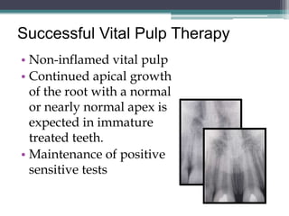 Successful Vital Pulp Therapy
• Non-inflamed vital pulp
• Continued apical growth
  of the root with a normal
  or nearly normal apex is
  expected in immature
  treated teeth.
• Maintenance of positive
  sensitive tests
 