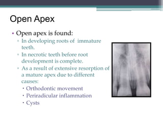 Open Apex
• Open apex is found:
 ▫ In developing roots of immature
   teeth.
 ▫ In necrotic teeth before root
   development is complete.
 ▫ As a result of extensive resorption of
   a mature apex due to different
   causes:
    Orthodontic movement
    Periradicular inflammation
    Cysts
 