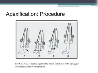 Apexification: Procedure




   The Ca(OH)2 is packed against the apical soft tissue with a plugger
   to initiate hard tissue formation.
 