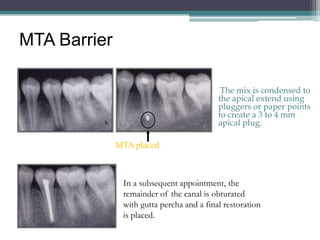 MTA Barrier

                                            The mix is condensed to
                                           the apical extend using
                                           pluggers or paper points
                                           to create a 3 to 4 mm
                                           apical plug.

              MTA placed



               In a subsequent appointment, the
               remainder of the canal is obturated
               with gutta percha and a final restoration
               is placed.
 