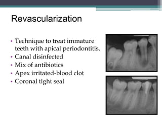 Revascularization

• Technique to treat immature
  teeth with apical periodontitis.
• Canal disinfected
• Mix of antibiotics
• Apex irritated-blood clot
• Coronal tight seal
 