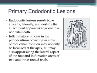 Primary Endodontic Lesions
• Endodontic lesions resorb bone
  apically, laterally, and destroy the
  attachment apparatus adjacent to a
  non vital tooth.
• Inflammatory process in the
  periodontium occurring as a result
  of root canal infection may not only
  be localized at the apex, but may
  also appear along the lateral aspect
  of the root and in furcation areas of
  two and three-rooted teeth.
 