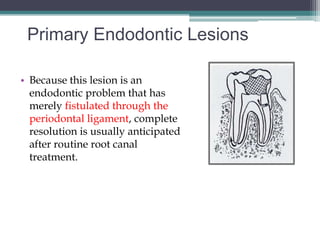 Primary Endodontic Lesions

• Because this lesion is an
  endodontic problem that has
  merely fistulated through the
  periodontal ligament, complete
  resolution is usually anticipated
  after routine root canal
  treatment.
 