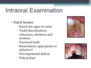 Intraoral Examination
  • Hard tissues
      Search for signs of caries
      Tooth discolorations
      Abrasions, attritions and
       erosions
      Fractured teeth
      Restorations: appropriate or
       defective?
      Developmental defects
      Pulp polyps
 