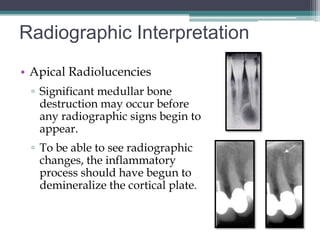 Radiographic Interpretation
• Apical Radiolucencies
 ▫ Significant medullar bone
   destruction may occur before
   any radiographic signs begin to
   appear.
 ▫ To be able to see radiographic
   changes, the inflammatory
   process should have begun to
   demineralize the cortical plate.
 