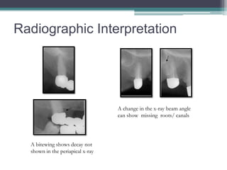 Radiographic Interpretation




                                  A change in the x-ray beam angle
                                  can show missing roots/ canals




  A bitewing shows decay not
  shown in the periapical x-ray
 