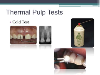 Thermal Pulp Tests
 • Cold Test
 