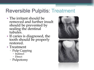 Reversible Pulpitis: Treatment
• The irritant should be
  removed and further insult
  should be prevented by
  sealing the dentinal
  tubules.
• If caries is diagnosed, the
  tooth should be properly
  restored.
• Treatment
 ▫ Pulp Capping
    Indirect
    Direct
 ▫ Pulpotomy
 