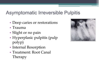 Asymptomatic Irreversible Pulpitis
 • Deep caries or restorations
 • Trauma
 • Slight or no pain
 • Hyperplasic pulpitis (pulp
   polyp)
 • Internal Resorption
 • Treatment: Root Canal
   Therapy
 