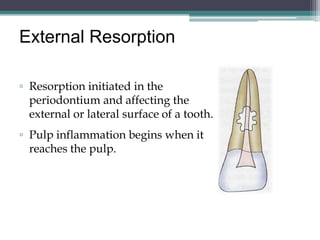 External Resorption

▫ Resorption initiated in the
  periodontium and affecting the
  external or lateral surface of a tooth.
▫ Pulp inflammation begins when it
  reaches the pulp.
 