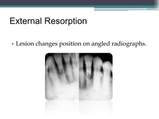 External Resorption

• Lesion changes position on angled radiographs.
 