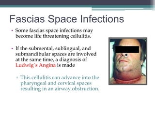 Fascias Space Infections
• Some fascias space infections may
  become life threatening cellulitis.

• If the submental, sublingual, and
  submandibular spaces are involved
  at the same time, a diagnosis of
  Ludwig´s Angina is made

  ▫ This cellulitis can advance into the
    pharyngeal and cervical spaces
    resulting in an airway obstruction.
 