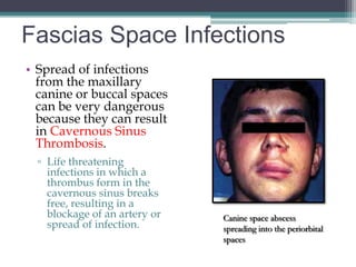 Fascias Space Infections
• Spread of infections
  from the maxillary
  canine or buccal spaces
  can be very dangerous
  because they can result
  in Cavernous Sinus
  Thrombosis.
  ▫ Life threatening
    infections in which a
    thrombus form in the
    cavernous sinus breaks
    free, resulting in a
    blockage of an artery or   Canine space abscess
    spread of infection.       spreading into the periorbital
                               spaces
 